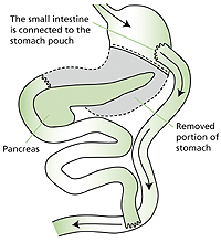Derivation bilio pancreatique
